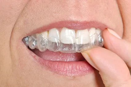 invisalign