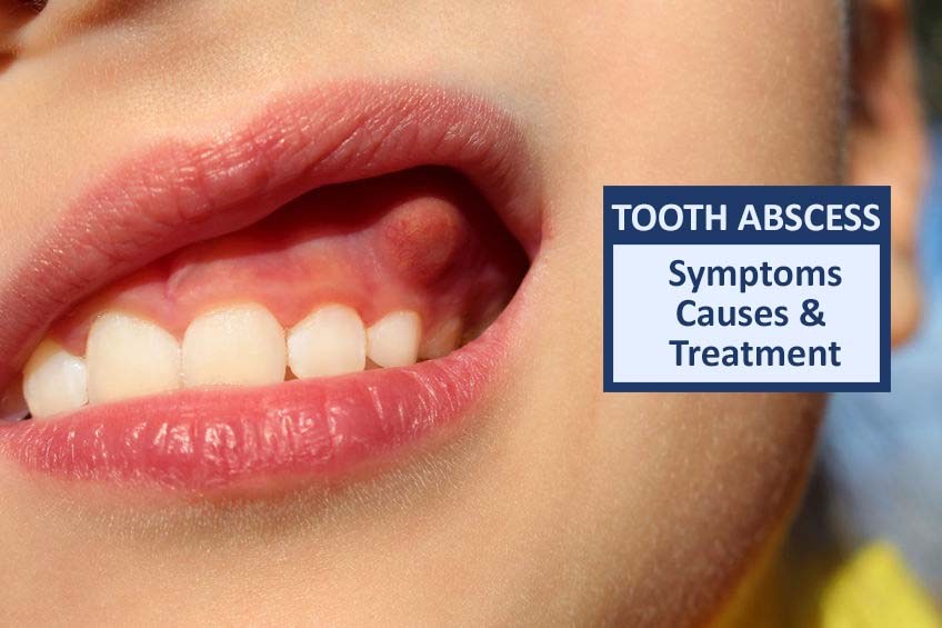 Tooth Eruption Abscess Tooth Abscess - Symptoms, Causes & Treatment