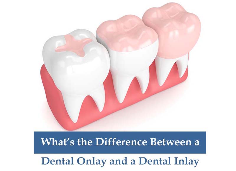 What's the Difference Between a Dental Onlay and a Dental Inlay